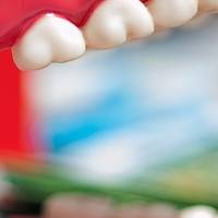 Типове пародонтологична профилактика 18 от MedicalDent Типове пародонтологична профилактика 18